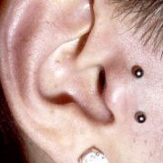 tragus en surface