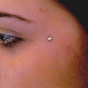 Microdermal