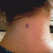 Microdermal