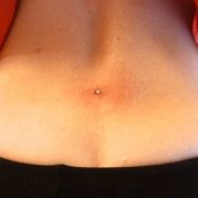 Microdermal