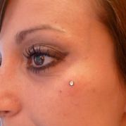 Microdermal