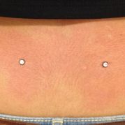 Microdermal