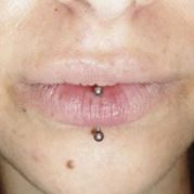 Labret vertical