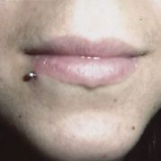 Labret décalé