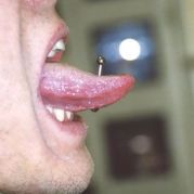 langue avec prothèse