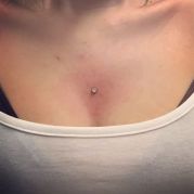 Microdermal poitrine